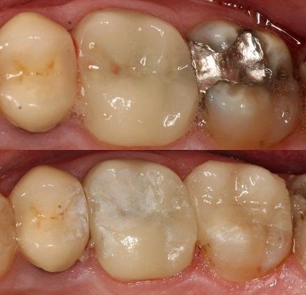 Nappy Lam DDS Portland Oregon Dentist Before And Afters